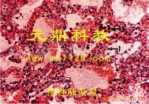 廠傢大量生產供應優質病理切片-慢性肺淤血工廠,批發,進口,代購